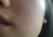 脸部皮肤过敏的症状,识别与应对策略
